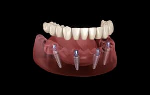 Dental implant package - ALL ON 4: DENTAL IMPLANTS