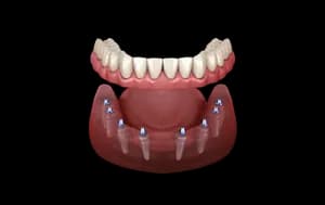 Dental implant package - ALL ON 8: DENTAL IMPLANTS
