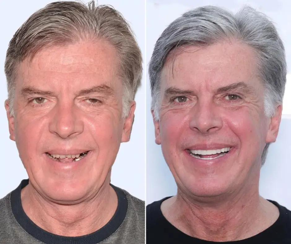 Before and after dental implant transformation of Michelle