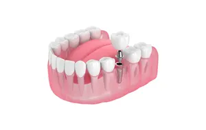Dental implant package - SINGLE: DENTAL IMPLANT