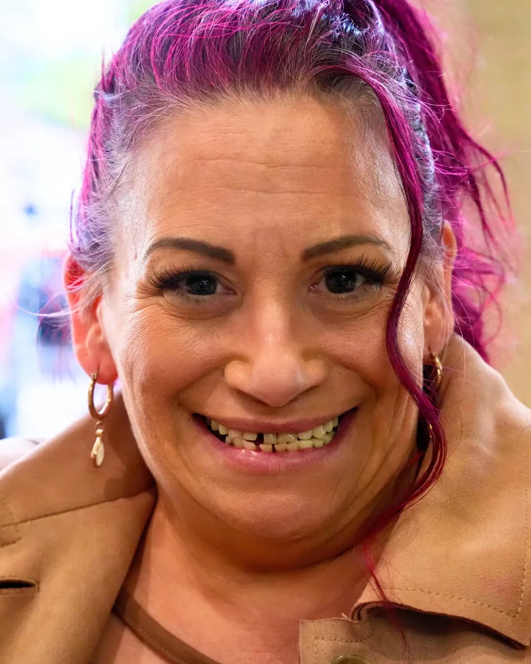 Denise dental implant smile transformation before treatment